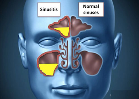 Endoscopic surgery for sinusitis