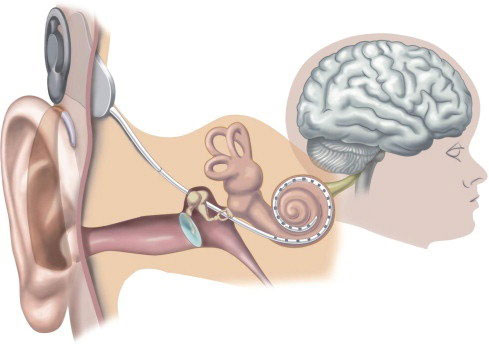 Cochlear Implantation